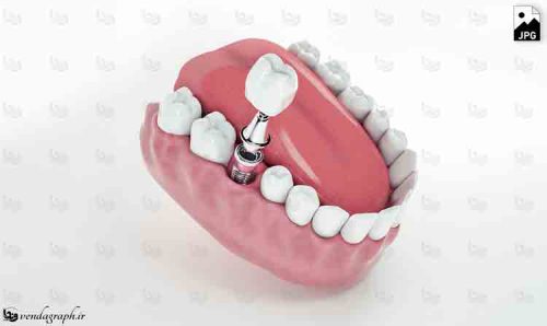 عکس باکیفیت و استوک از  ایمپلنت دندان و دندانپزشکی